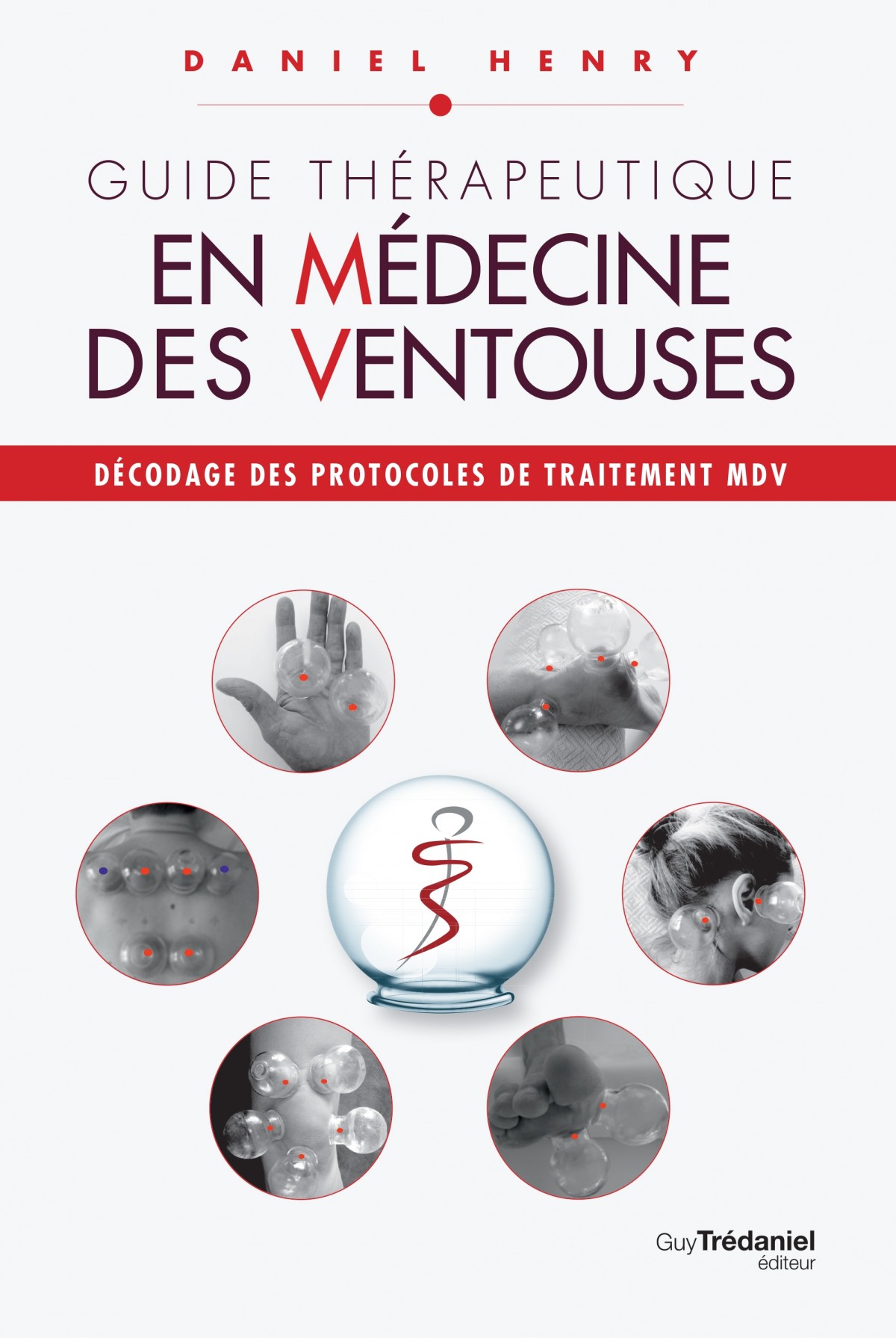 La médecine des ventouses